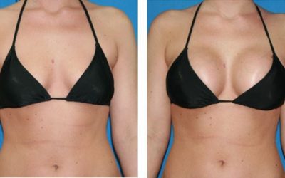 De ce sa alegi un implant mamar in Bucuresti