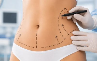 Ce Rezultate Poți Obține Prin Liposucție